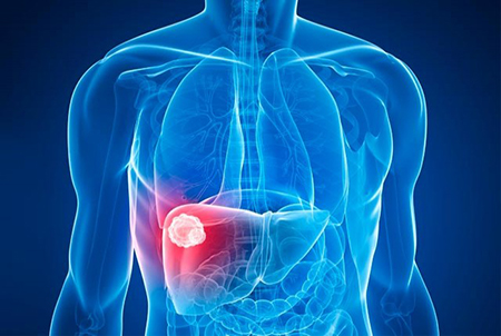 Καρκίνος Ήπατος Καρκίνος Ήπατος