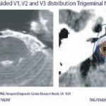 Νευραλγία του Τριδύμου